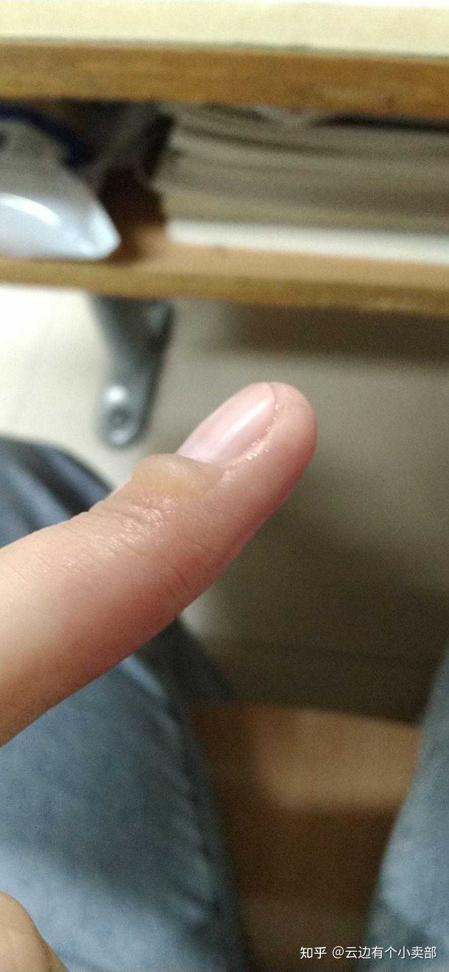 烫水泡会留疤吗_被烫出水泡之后可以发货吗_拿手机玩游戏烫出水泡了